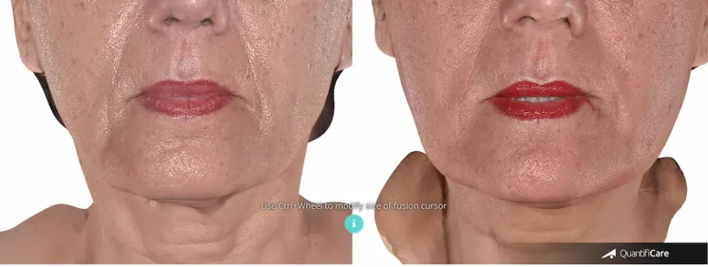 Endolift Before & After London