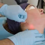 Endolift laser procedure for skin tightening and jawline contouring – Skinhorizon Clinic London