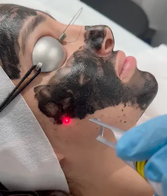 Step 3: Laser passes during carbon laser peel