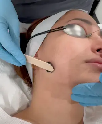 Step 2: Carbon lotion application before laser passes