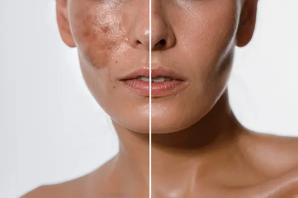 Melasma Treatment in London