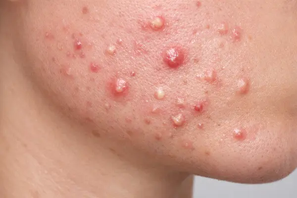 Acne Treatment in London
