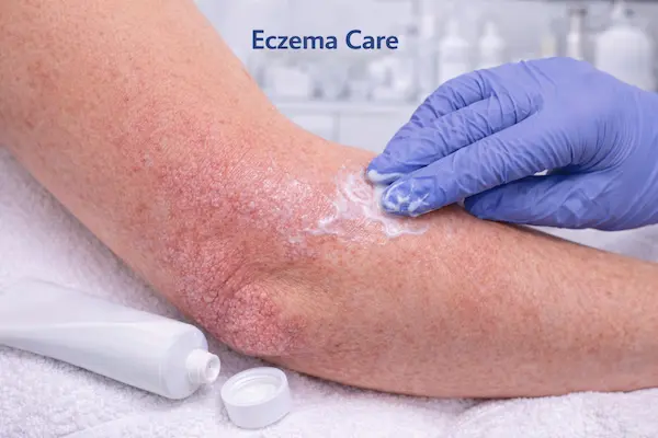 Private Eczema Care Explained