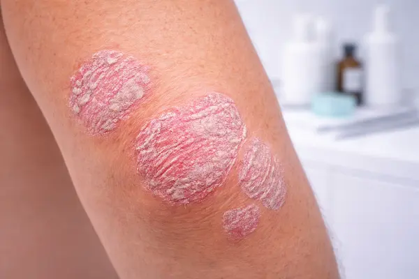 Psoriasis Treatment by Dermatologist London