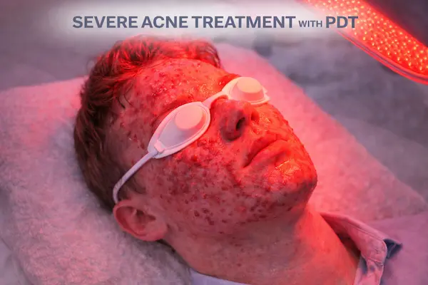 Severe Acne Treatment with PDT