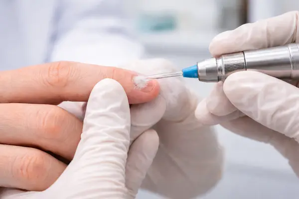 Wart Removal London